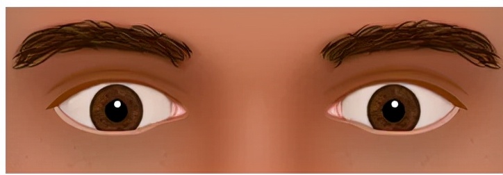 怎么判断间歇性外斜视,间歇性外斜视怎么算是严重