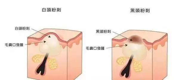 黑头可以用什么药膏来治疗,鼻子上的黑头怎么来的