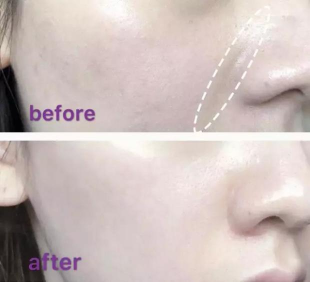 硬刚女皇龙妈也扛不住法令纹,2条沟壑让人心疼,贴一贴就消了