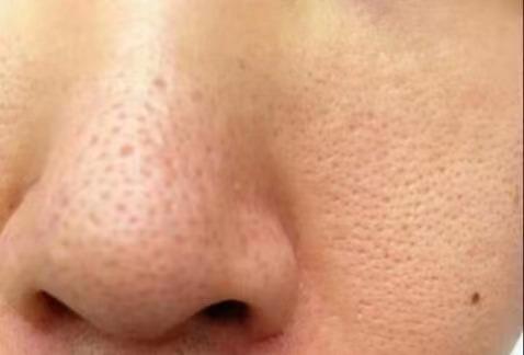 李佳琦安利的去黑头神器到底怎么样？我来替你们尝试了