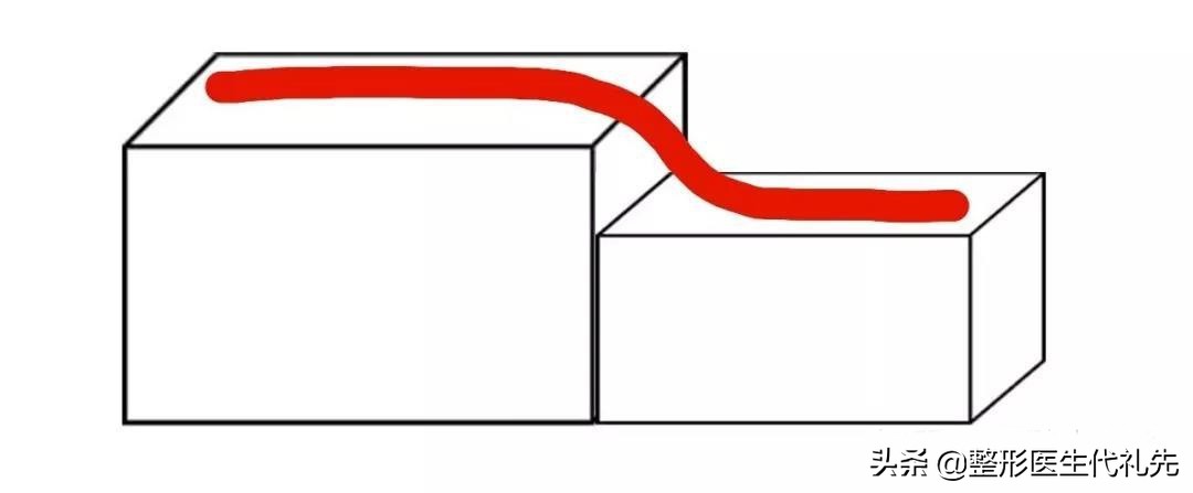 拉皮贴神器去法令纹有用吗,拉皮手术可以去除法令纹
