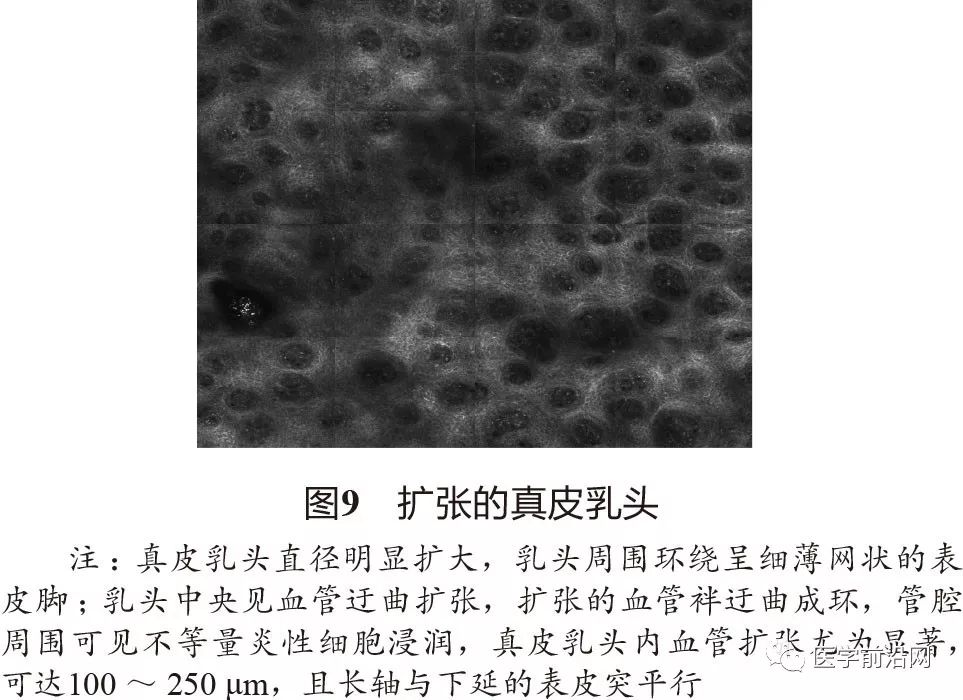 炎症性皮肤病反射式共聚焦显微镜诊断特征专家共识全文发布