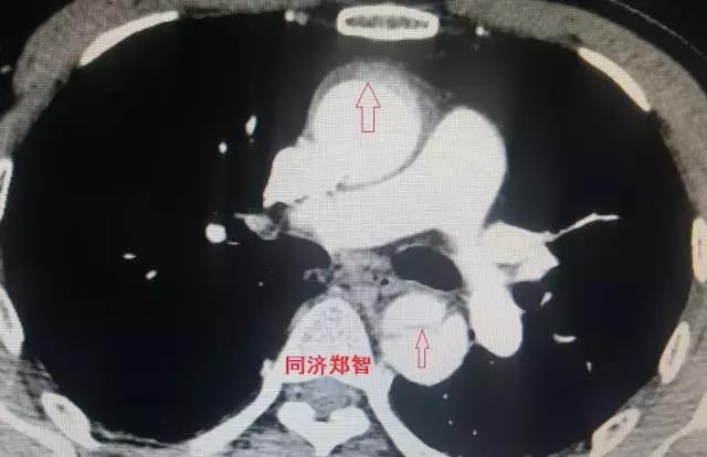 磁共振可以替代cta检查主动脉夹层,超声心动图联合cta诊断主动脉夹层