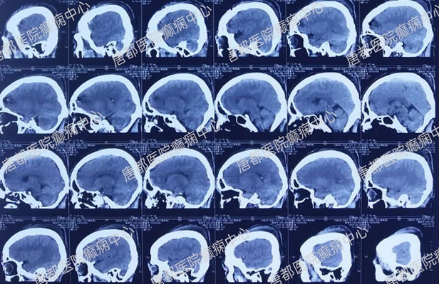 颞叶海绵状血管瘤癫痫微创手术,唐都医院脑肿瘤微创手术