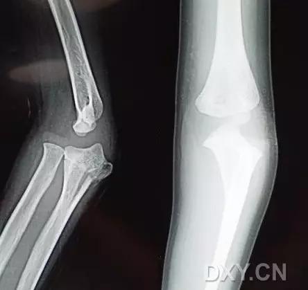 特殊骨折类型,特殊骨折体征