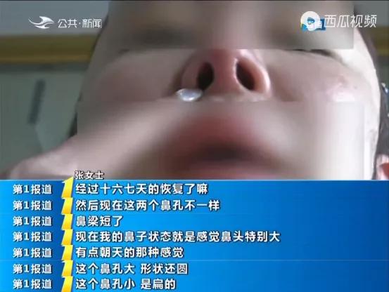 女子爱美做鼻综合手术,女人爱美去整形医院