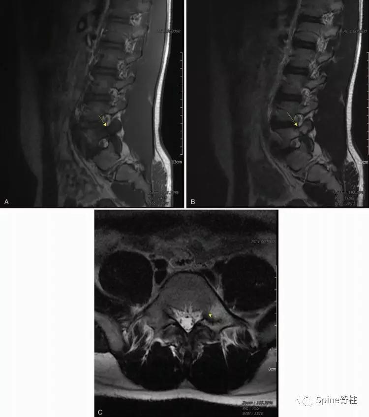 青少年一跑步就腰痛,青少年腰痛是什么原因引起的