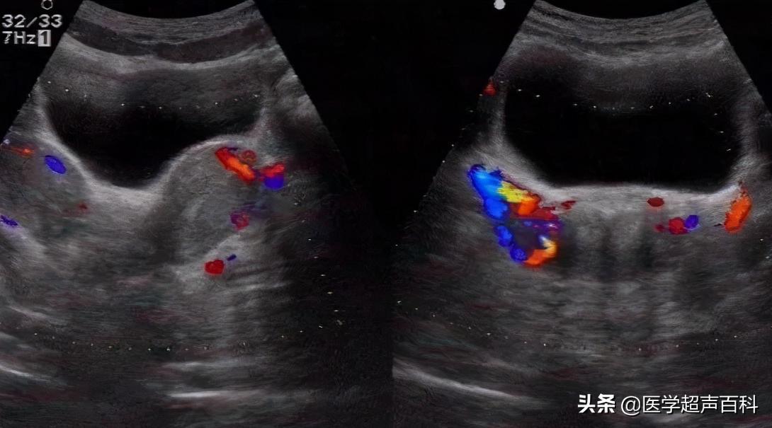 子宫发育正常是否会子宫幼稚,幼稚子宫和子宫发育不良的区别