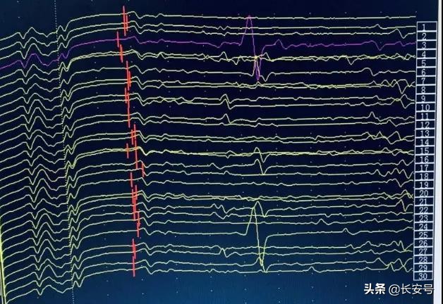 中风一侧手脚无力怎么恢复按摩图,医疗科普四肢无力是按摩惹的祸吗