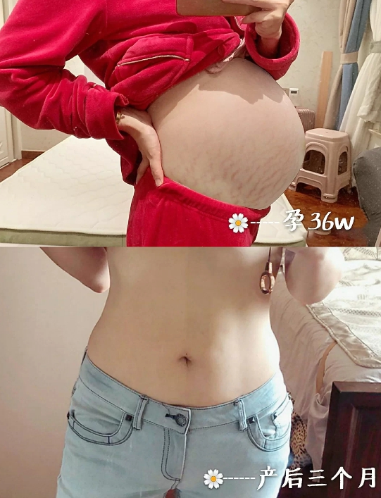 十大祛妊娠纹产品排行榜,妊娠纹产品哪个效果好