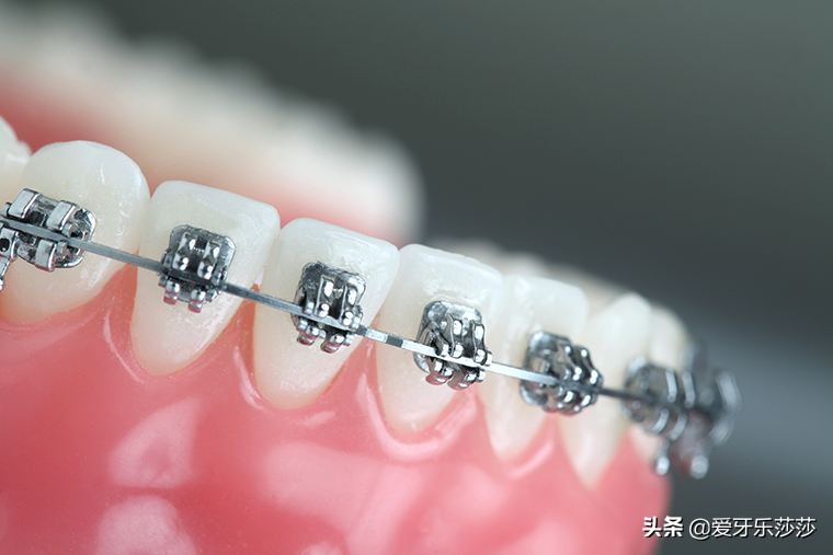 成人戴烤瓷冠能牙齿矫正吗,烤瓷冠牙齿矫正