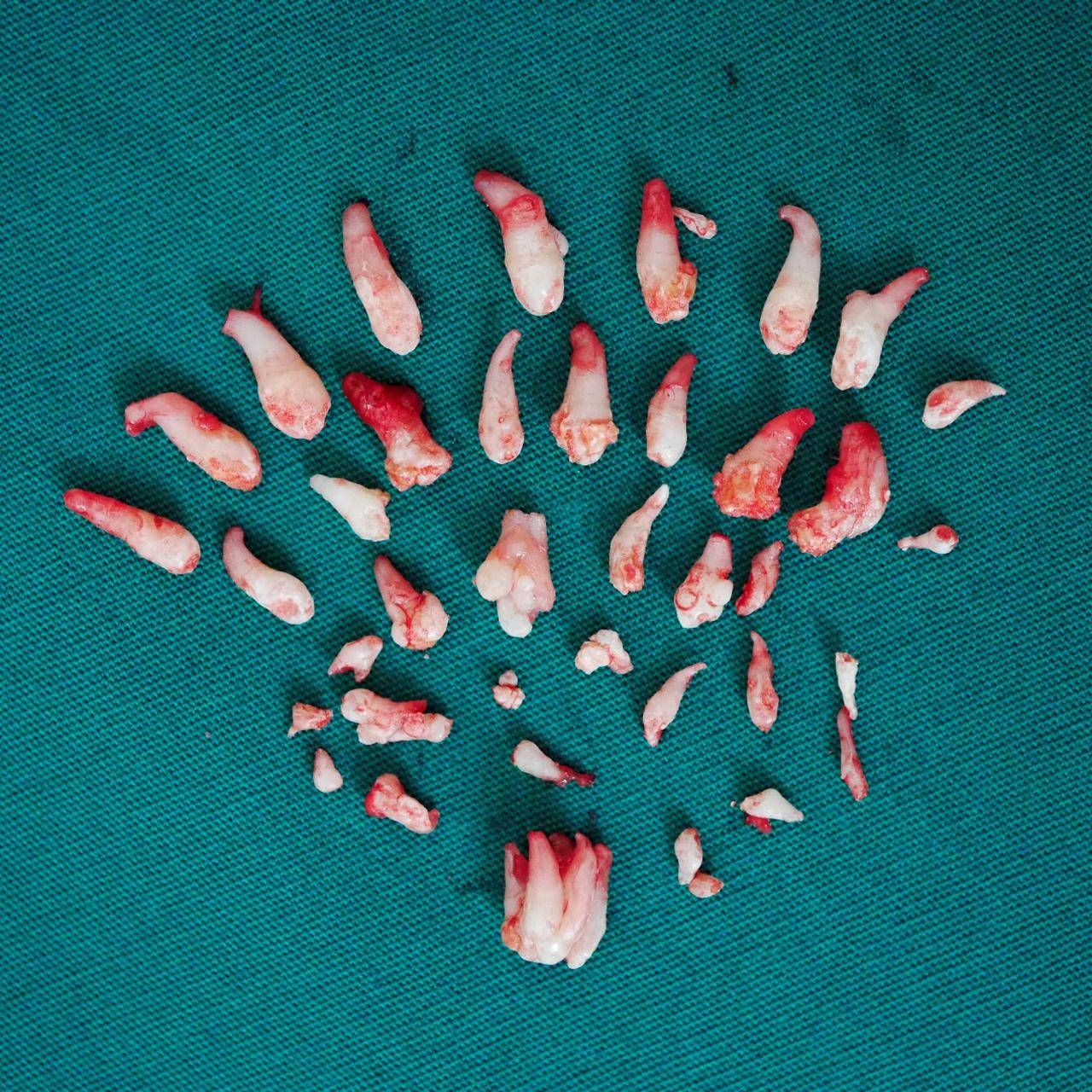 11岁男孩肿瘤手术后续,12岁男孩牙瘤手术后遗症