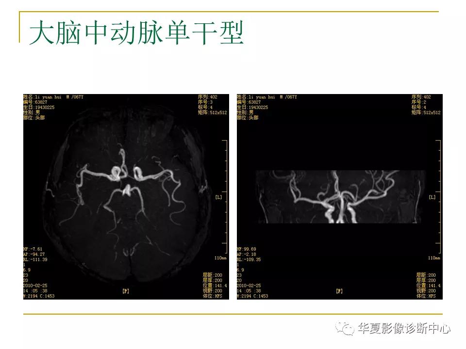 中国人脑立体定向mri应用解剖图谱,脑mri示意图