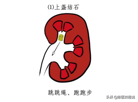 发现肾结石怎样治疗更好,发现肾结石怎么办