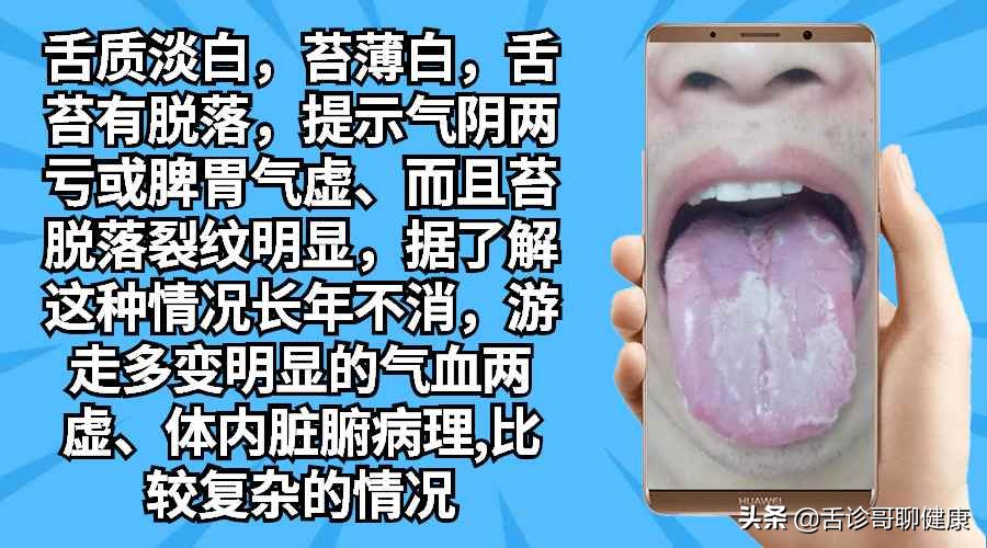 舌诊哥舌象分析阳虚体质,舌诊歌舌象分析和感悟
