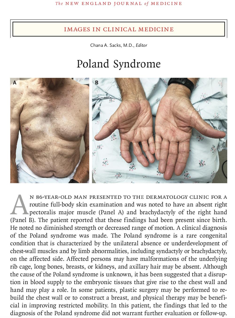 先天胸肌缺失锻炼回来了,poland综合症胸肌