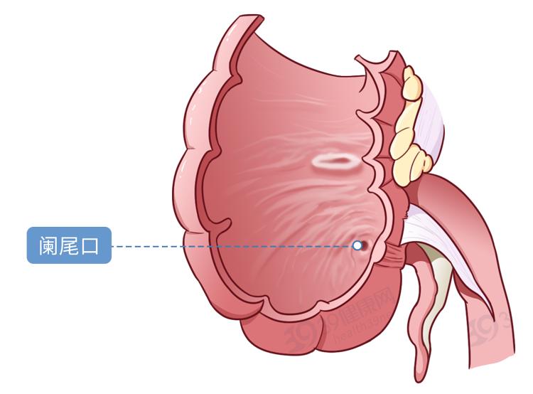 急性阑尾炎疼到什么程度,急性阑尾炎为什么那么急