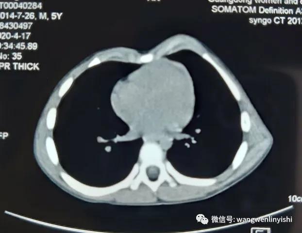 wenlin手术,wenlin手术怎么样