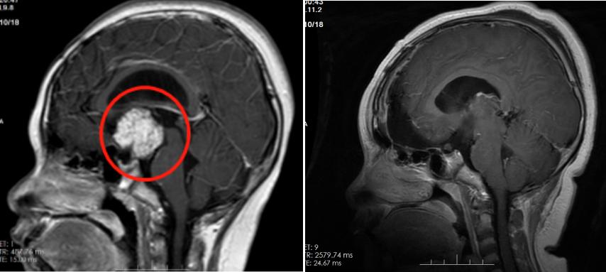 13岁女孩不长个正常吗,12岁孩子脾胃虚弱不长个子怎么办