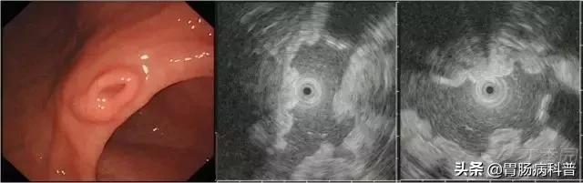 胃窦粘膜下隆起病变是胃癌吗,胃镜报告胃窦伴有隆起