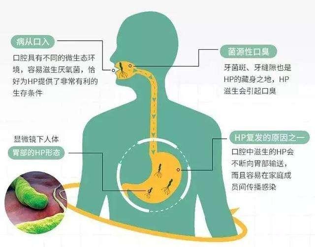 胃幽门螺旋杆菌感染是怎么回事,关于胃幽门螺旋杆菌的知识和治疗