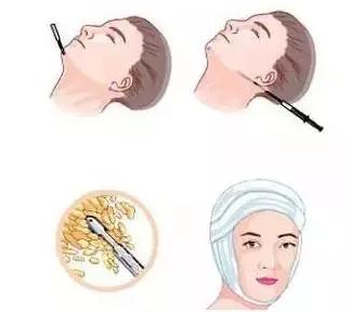 做完面部吸脂有效果吗?为什么我做了看不出来