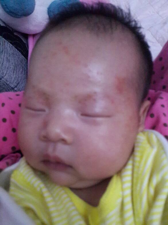 新生儿湿疹怎么护理最有效,新生儿屁股上有湿疹怎么护理