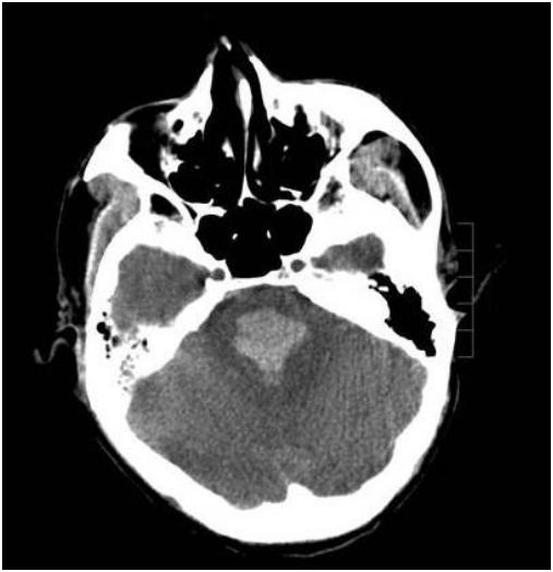 45岁脑干出血死亡父母怎么办,37岁脑干出血睁眼睛了