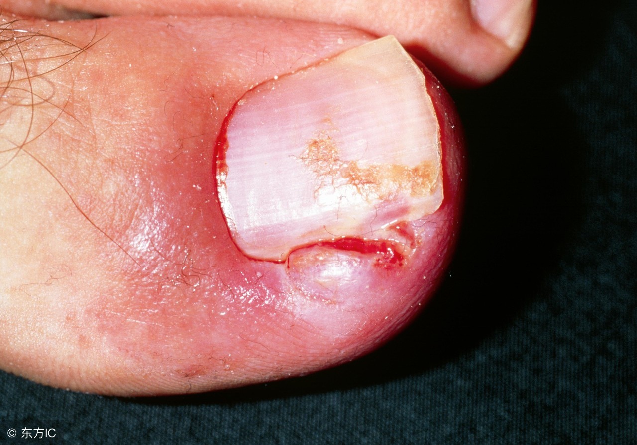 得了甲沟炎最好的处理办法,得了甲沟炎怎么正确处理