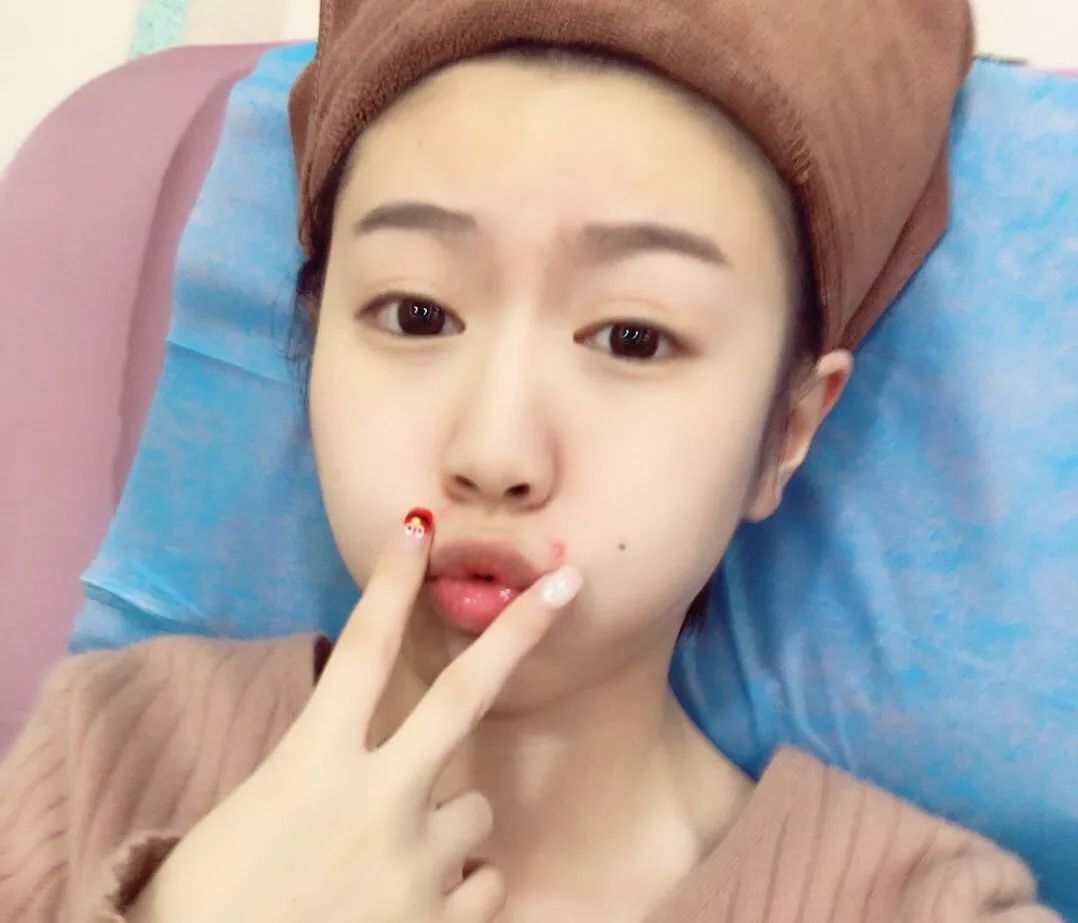 我用过敏、痘痘、水光针的脸，测评了4款“网红”面膜