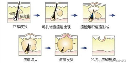15岁男孩挤青春痘感染,挤痘感染致死案例