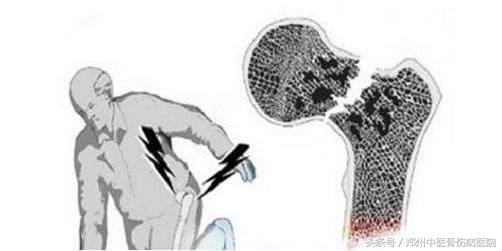 股骨头坏死与坐骨神经痛症状区别,股骨头坏死引起膝关节什么部位痛