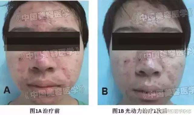 光动力治疗后出现脓包是什么情况,光动力治疗后脓包痘几天恢复