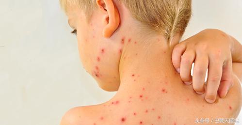 孩子出疹子宝妈需要忌口哪些,宝妈身上起疹子怎么办