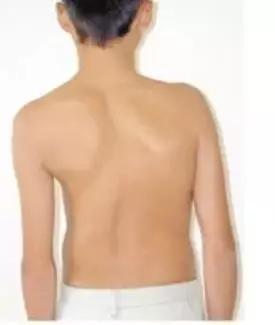 孩子脊柱弯了怎么矫正视频,孩子的脊柱怎么弯