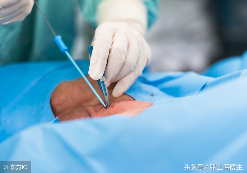 颈动脉多发斑怎么治疗,左侧颈动脉见多发斑块回声