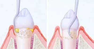 睡觉醒来后牙龈出血是什么原因,早上醒来口苦牙龈出血怎么回事