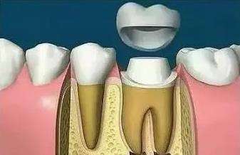 牙疼是不是拔牙就可以缓解,牙疼并且牙齿有松动要拔牙吗