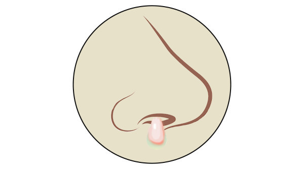 流不同颜色的鼻涕代表什么,鼻子有浓稠黄鼻涕是什么原因