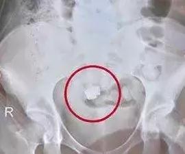 手术缝针忘记了一根线有啥事没,手术室里面针掉了不见了怎么办