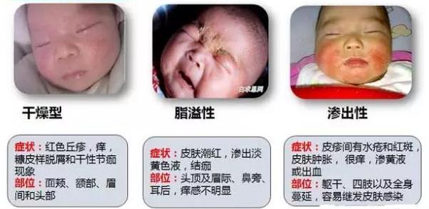 关于儿童湿疹你必须了解的事,宝宝湿疹说说