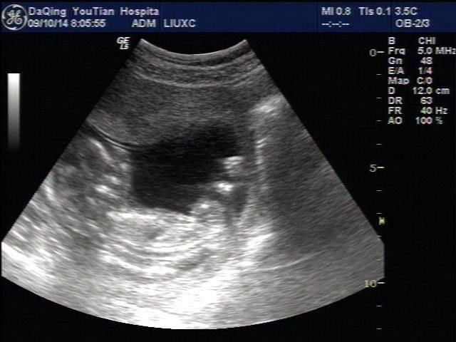 孕检做b超有尿意就行吗,怀孕做b超医生会标注什么