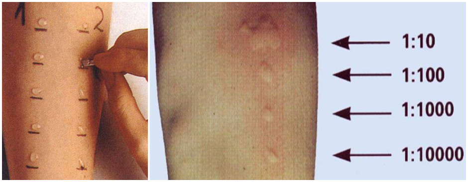 婴儿结膜炎过敏源图片,过敏性结膜炎怎么找过敏原