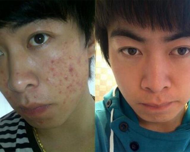 男士祛痘祛痘印小窍门,男士怎么祛痘祛痘印效果好