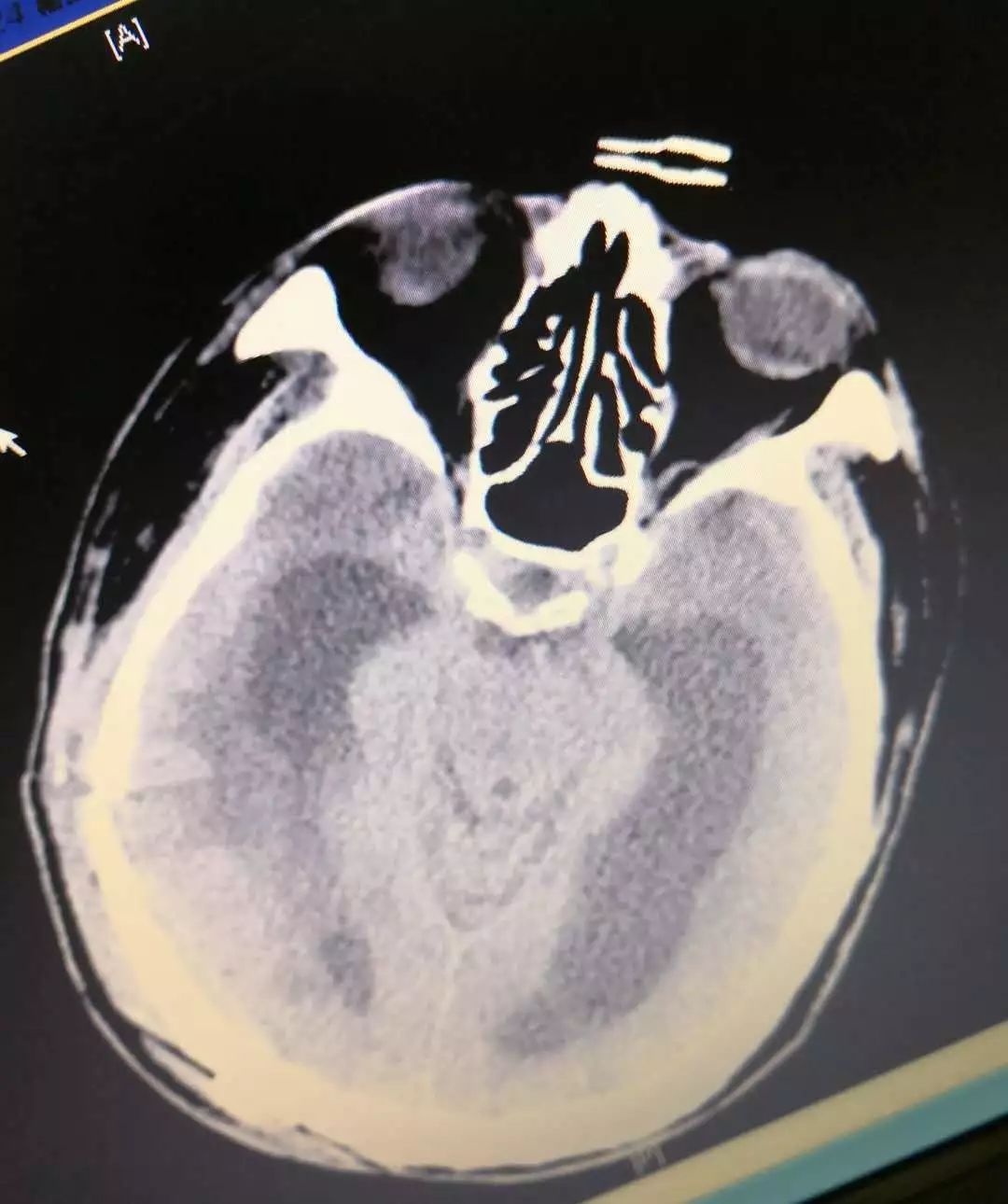 幼儿脑积水首选术式,脑积水微创术是外引流吗