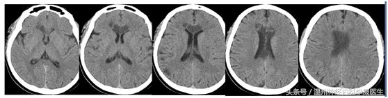 张景明教授讲脑中风后遗症,李医生讲中风视频全集