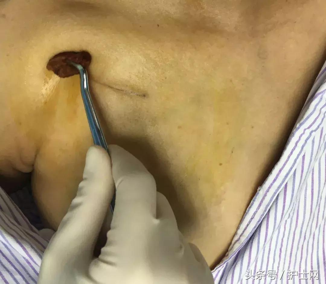 输液港扎针最全示范,输液港拔针的正确方法视频教程