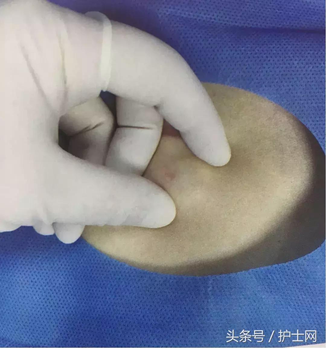 输液港扎针最全示范,输液港拔针的正确方法视频教程