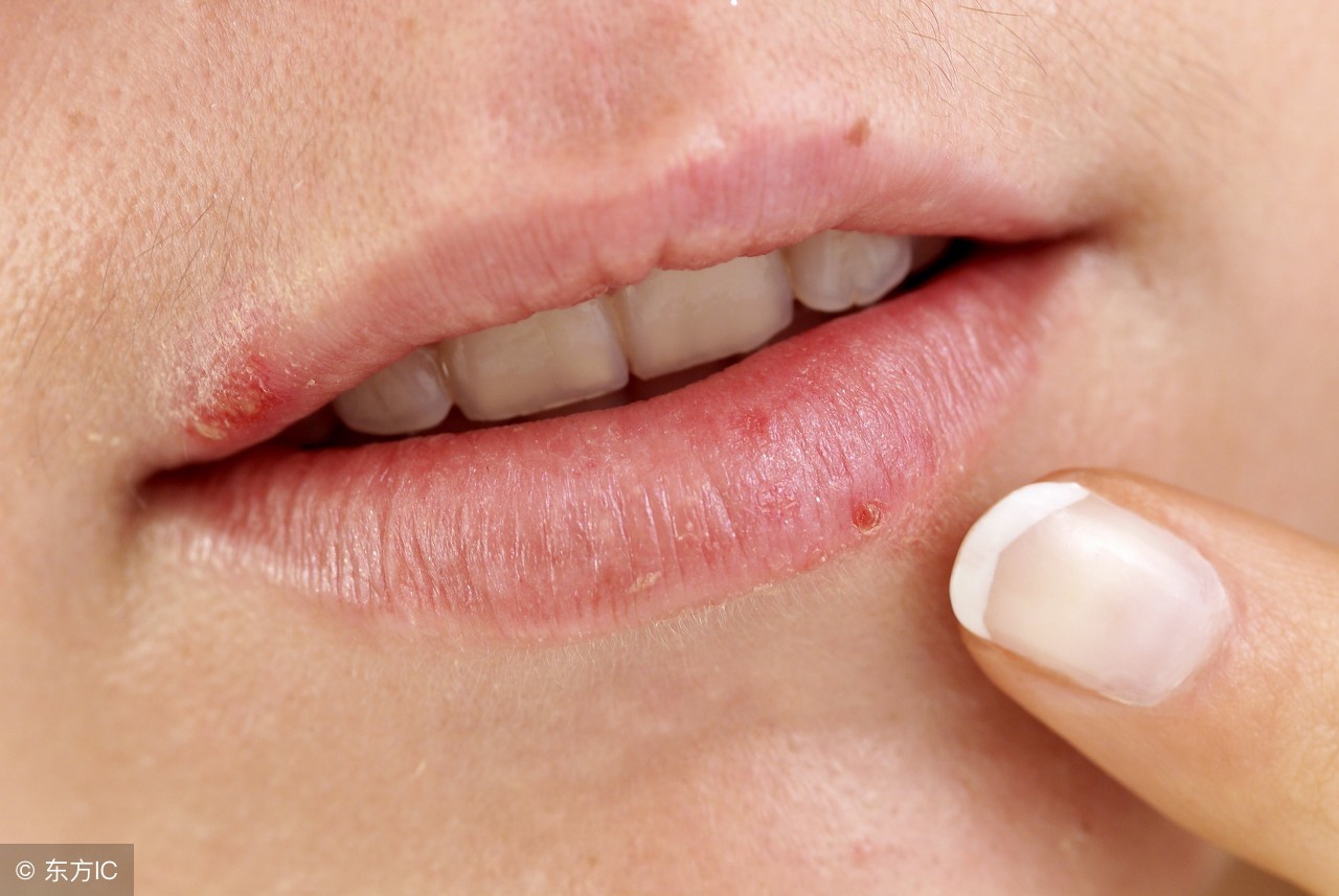 嘴唇上火起痘是什么原因,嘴唇上火长痘了怎么快速消除