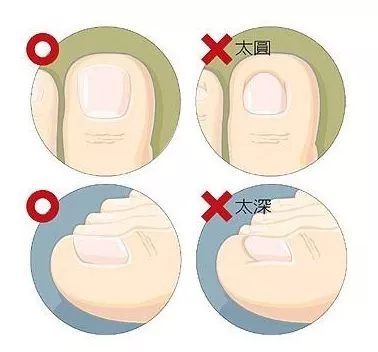 宝宝趾甲总是往肉里长，越剪越严重怎么办！